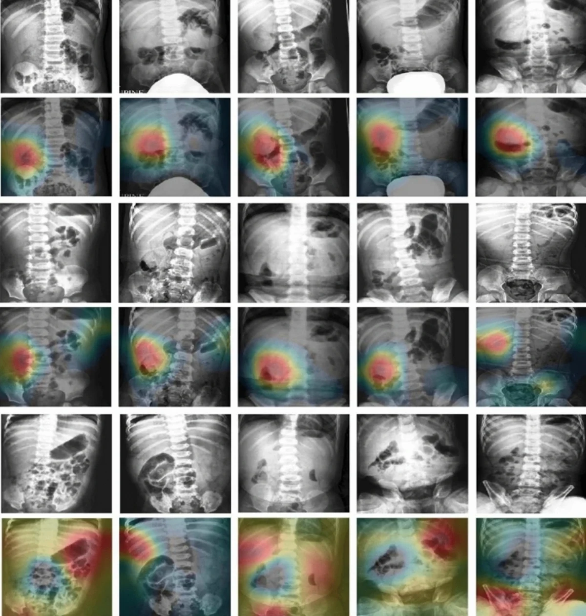 Figure 3 showing pairs of paediatric abdominal radiographs and their class activation maps, where the heatmap overlay highlights the region the model used to detect intussusception.